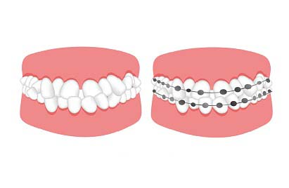  dental dentures malocclusion